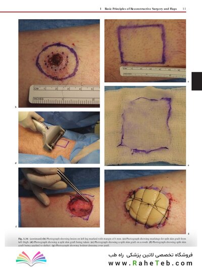 Flaps : Practical Reconstructive Surgery