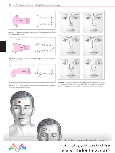 Flaps : Practical Reconstructive Surgery