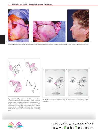 Flaps : Practical Reconstructive Surgery