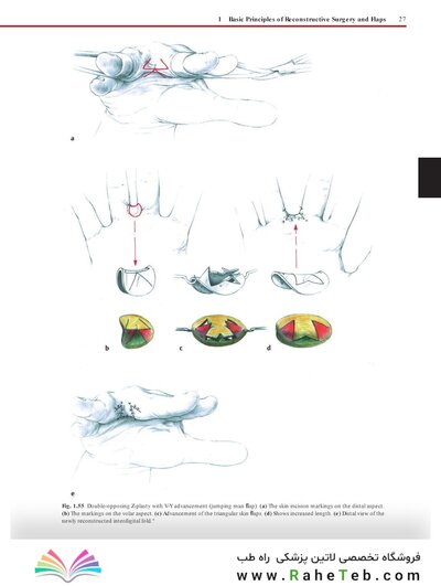 Flaps : Practical Reconstructive Surgery