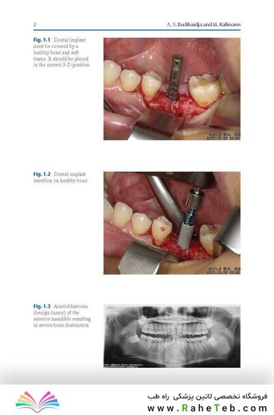 Bone Management in Dental Implantology 1st ed. 2019 Edition