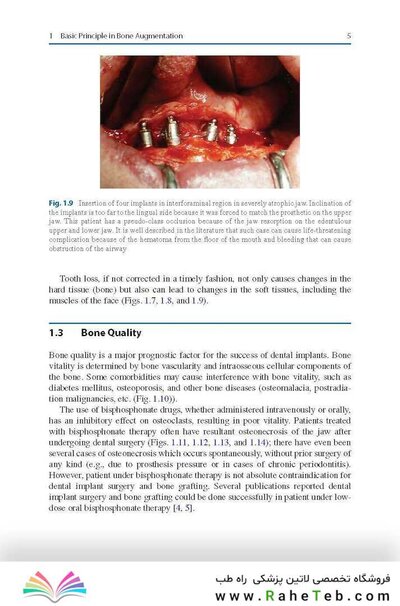 Bone Management in Dental Implantology 1st ed. 2019 Edition