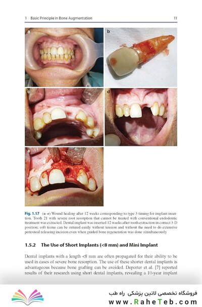 Bone Management in Dental Implantology 1st ed. 2019 Edition