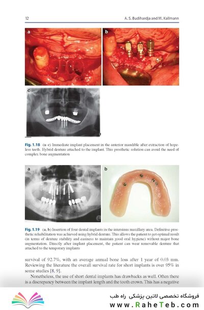 Bone Management in Dental Implantology 1st ed. 2019 Edition
