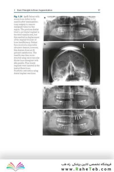 Bone Management in Dental Implantology 1st ed. 2019 Edition