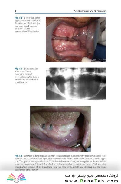 Bone Management in Dental Implantology 1st ed. 2019 Edition