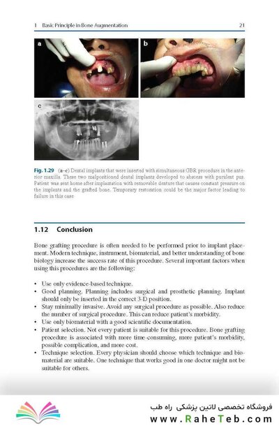 Bone Management in Dental Implantology 1st ed. 2019 Edition
