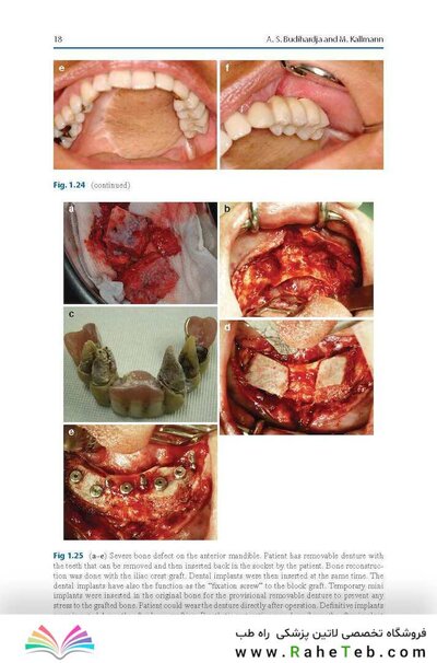 Bone Management in Dental Implantology 1st ed. 2019 Edition