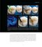 Restoring with Flowables, 1st Edition2017