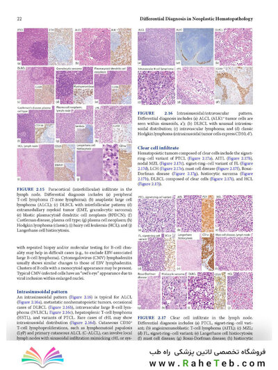 Atlas of Differential Diagnosis in Neoplastic Hematopathology2021