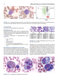 Atlas of Differential Diagnosis in Neoplastic Hematopathology2021