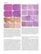 Atlas of Differential Diagnosis in Neoplastic Hematopathology2021