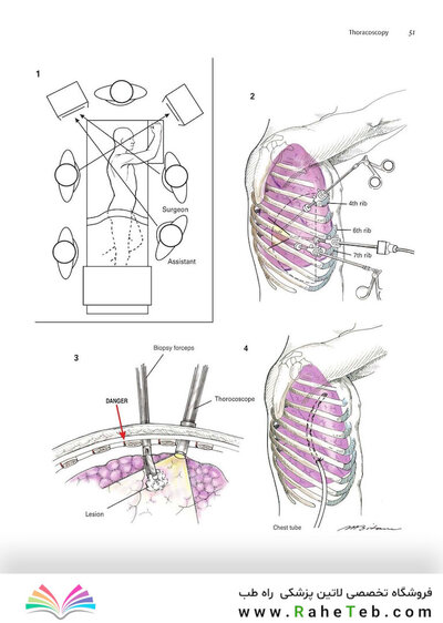 Zollinger's Atlas of Surgical Operations, Eleventh Edition 11th Edition