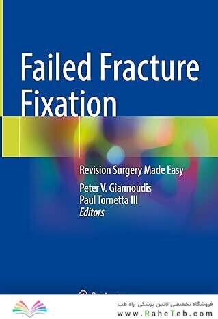 Failed Fracture Fixation: Revision Surgery Made Easy