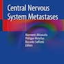 Central Nervous System Metastases متاستازهای سیستم عصبی مرکزی
