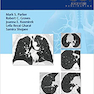 Lung Cancer Screening 1st Edition2017 غربالگری سرطان ریه