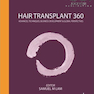 Hair Transplant 360 1st Edition2014 کاشت مو 360