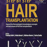 Step by Step Hair Transplantation 2019 کاشت مو به صورت مرحله به مرحله