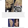 Youmans and Winn Neurological Surgery: 4 - Volume Set 2023
