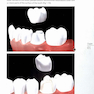 Tooth Preparations 1st Edicion 2017