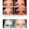 Procedures in Cosmetic Dermatology: Botulinum Toxin 5thEdition