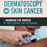Dermatoscopy and Skin Cancer : A handbook for hunters of skin cancer and melanoma 2019 درماتوسکوپی و سرطان پوست: کتاب راهنما سرطان پوست