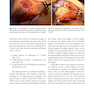 Augmentation Mastopexy: Mastering the Art in the Management of the Ptotic